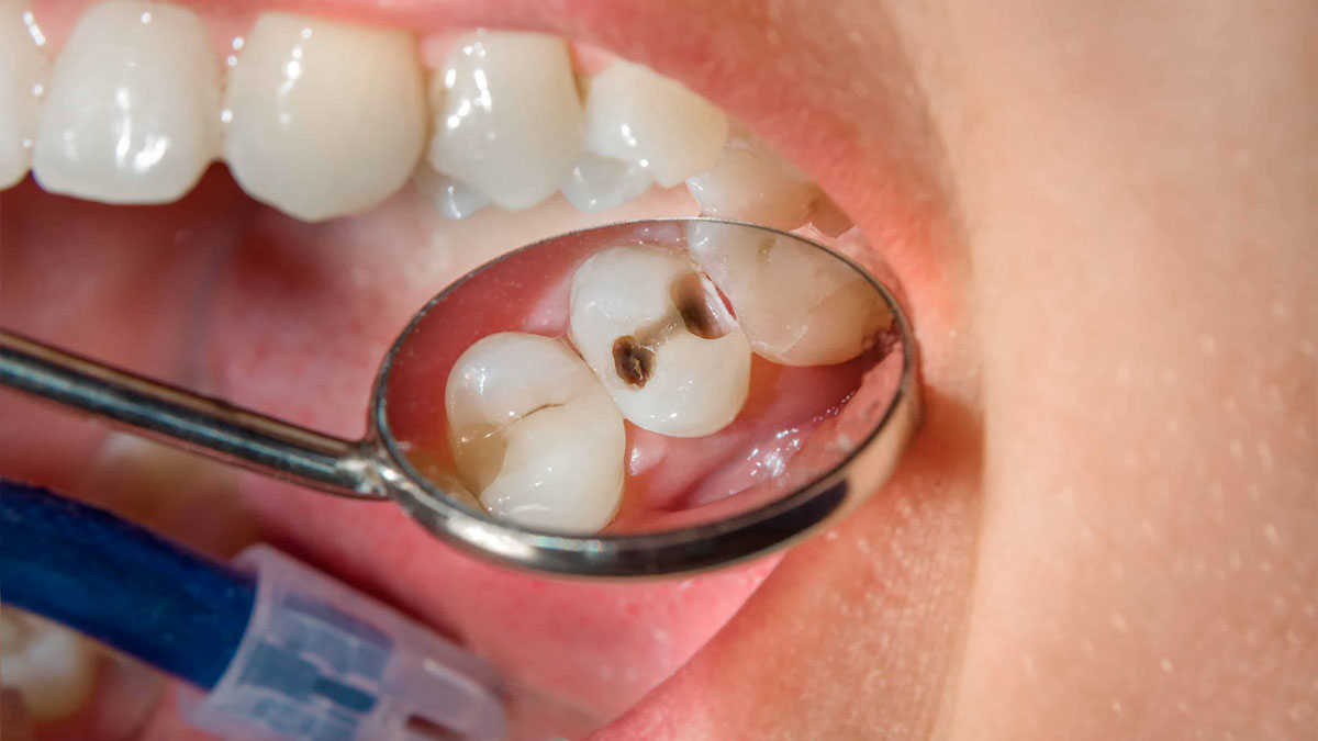 Лечение зубов больных кариесом