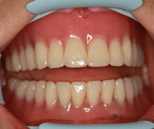 Частично съемные зубные протезы