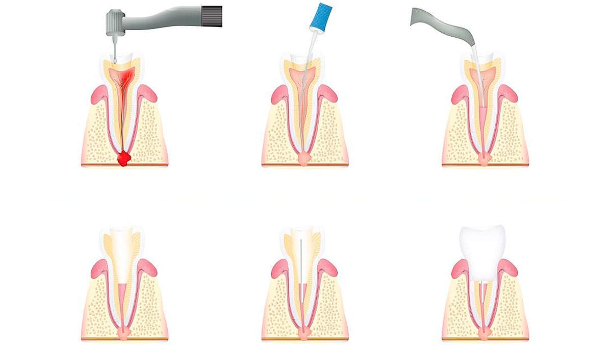 Стадии лечения зубов от кариеса